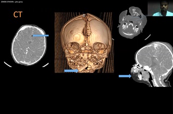 Penn Global Health 2021 Imaging Case Competition: Yohannes Zewdie presentation slide, head imaging
